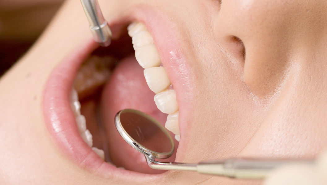 布施のなるべく歯を削らない治療