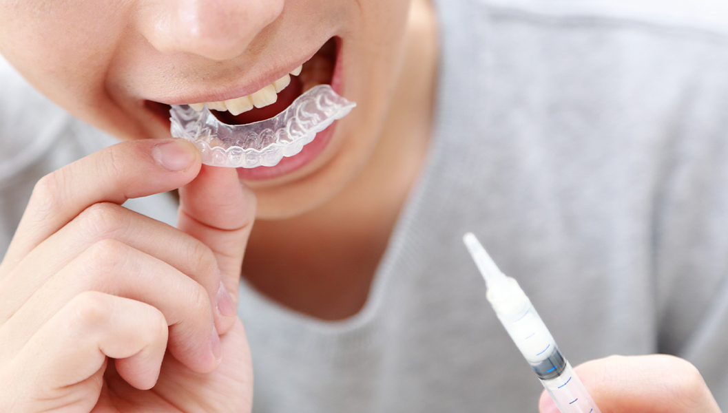 布施のホームホワイトニング