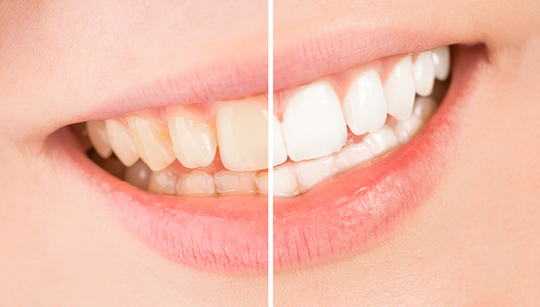 布施のオフィスホワイトニング