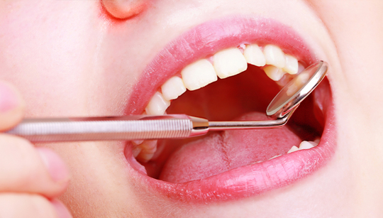 布施のホームホワイトニング