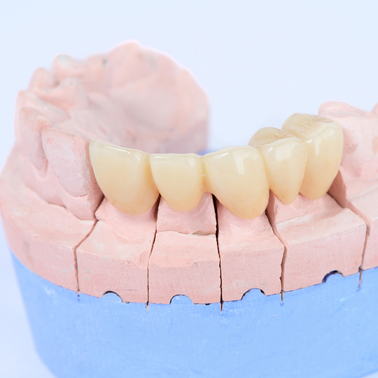 布施のセラミック治療