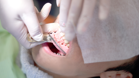 布施の入れ歯の治療