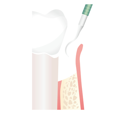布施の歯周病の治療