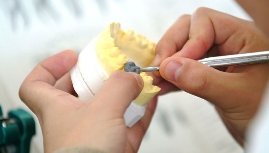 布施のノンクラスプデンチャー