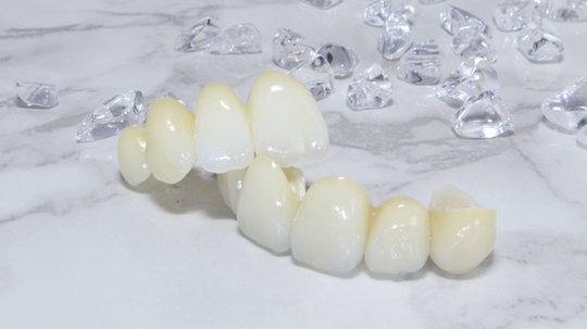 布施のセラミック治療